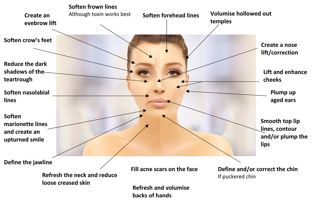 Diagram of areas that Dermal HA Fillers can be used to treat