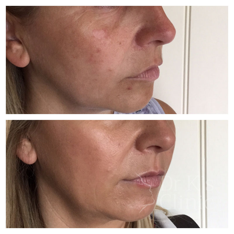 Before and after photo of PDO threads in Chester