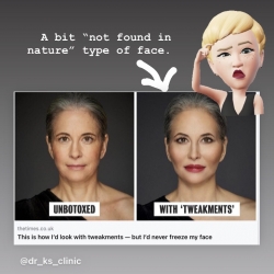 Will Botox and fillers make me look weird?