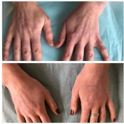 Ellans&eacute; and treatments for ageing hands